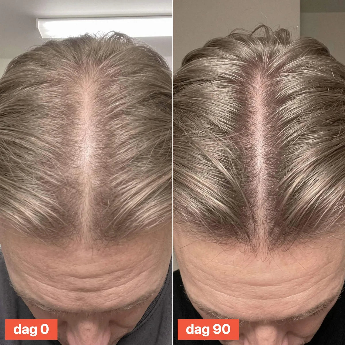Top-down view of a hair parting on day 0 and day 90.