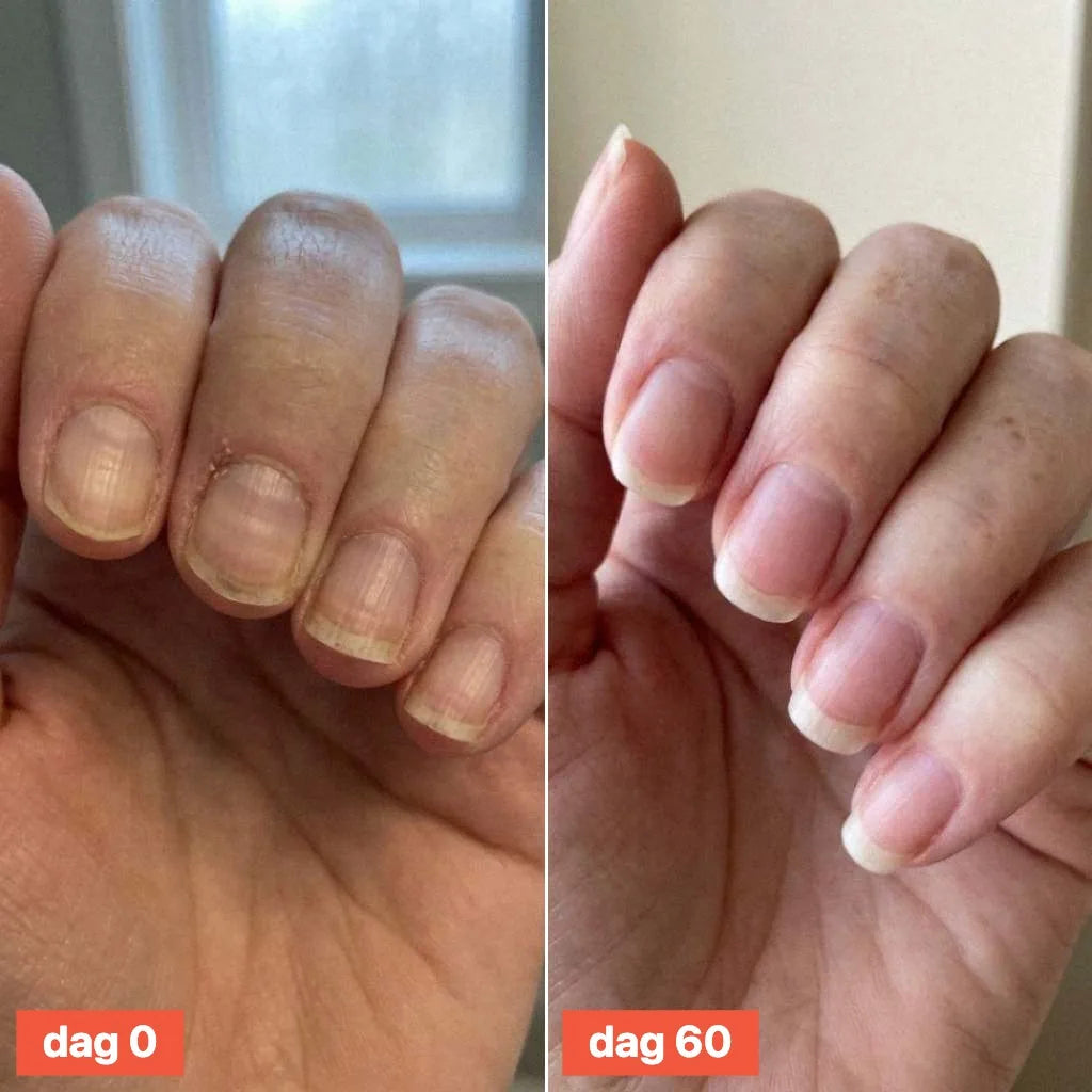 Close-up of fingernails on day 0 and day 60.