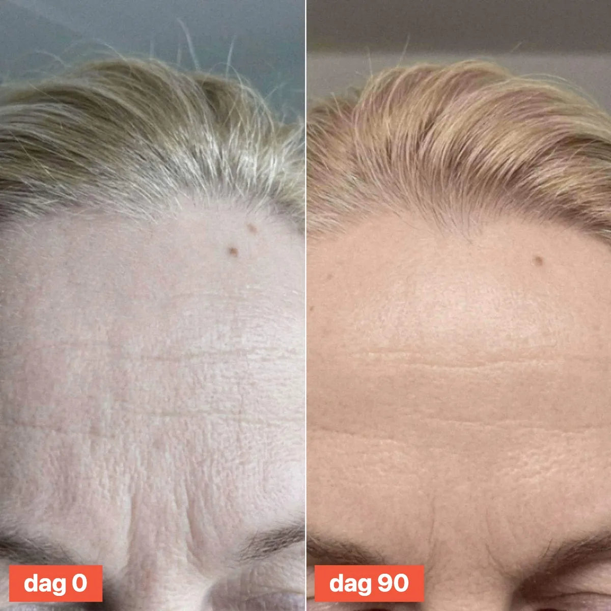 Close-up of a forehead on day 0 and day 90.