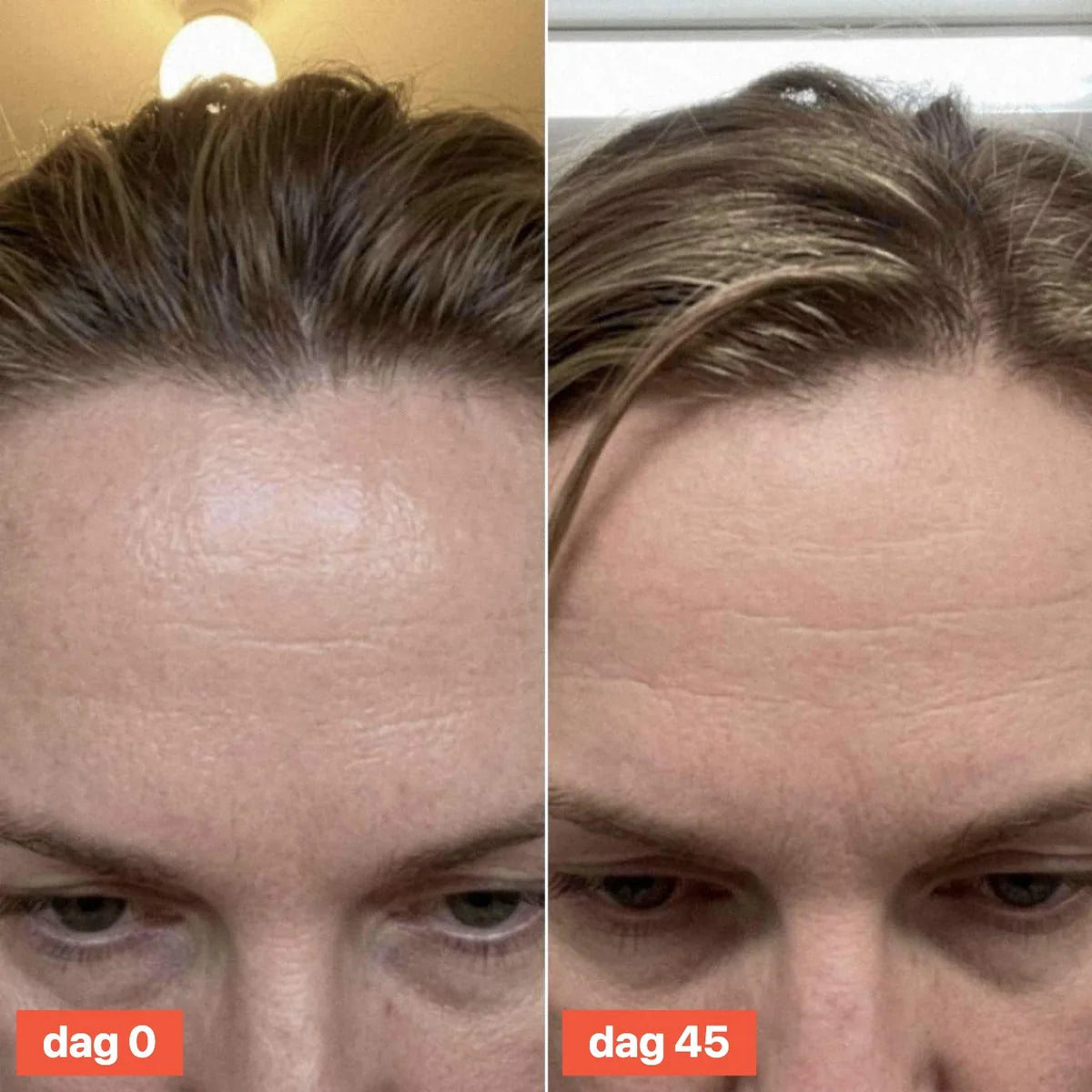 Close-up of a forehead on day 0 and day 45.