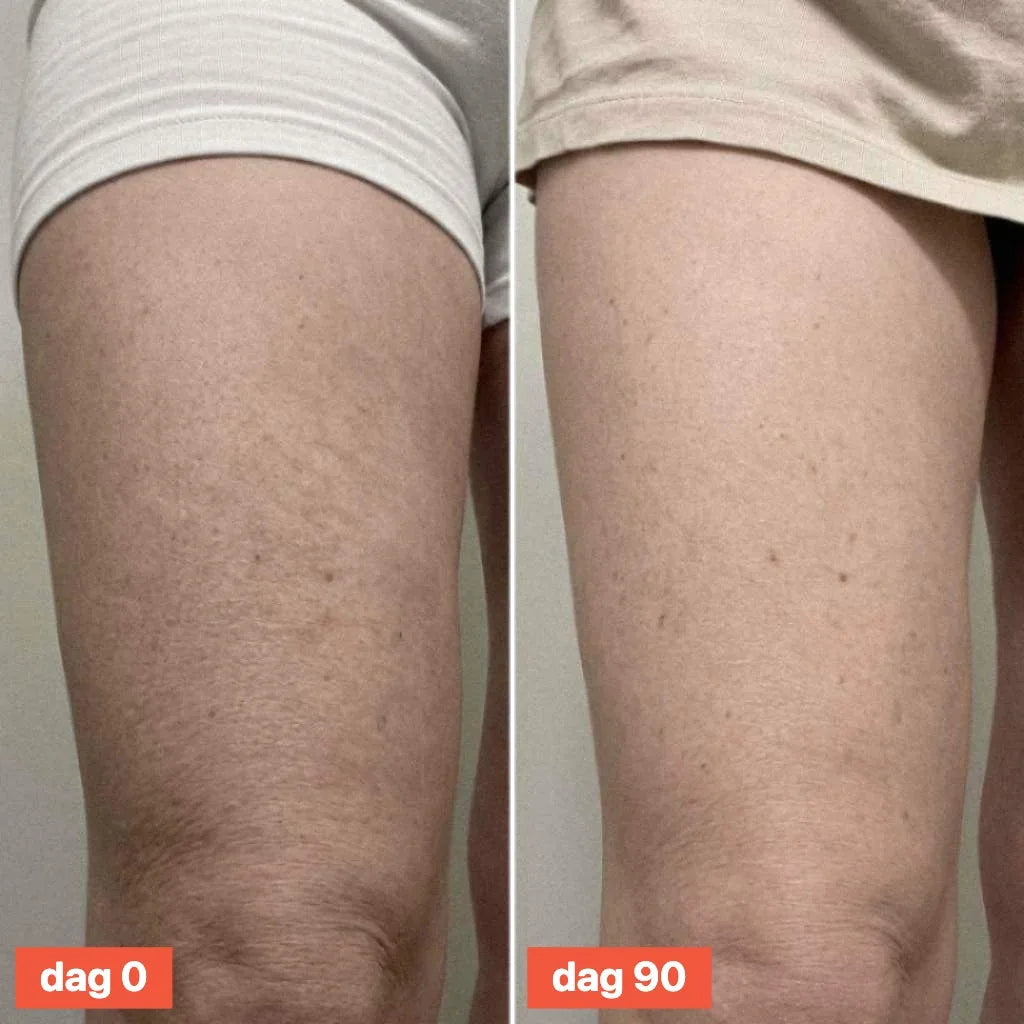 Close-up of thigh skin on day 0 and day 90.