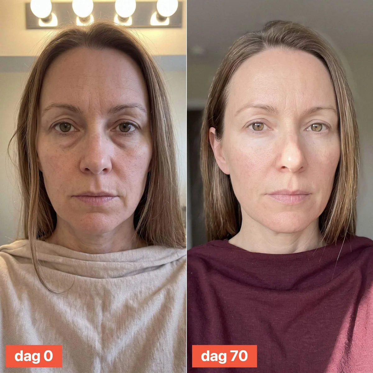 Front view of a woman's face on day 0 and day 70, with little visible change.