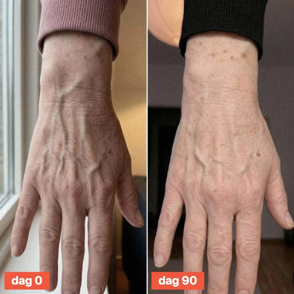 Close-up of the back of a hand on day 0 and day 90.