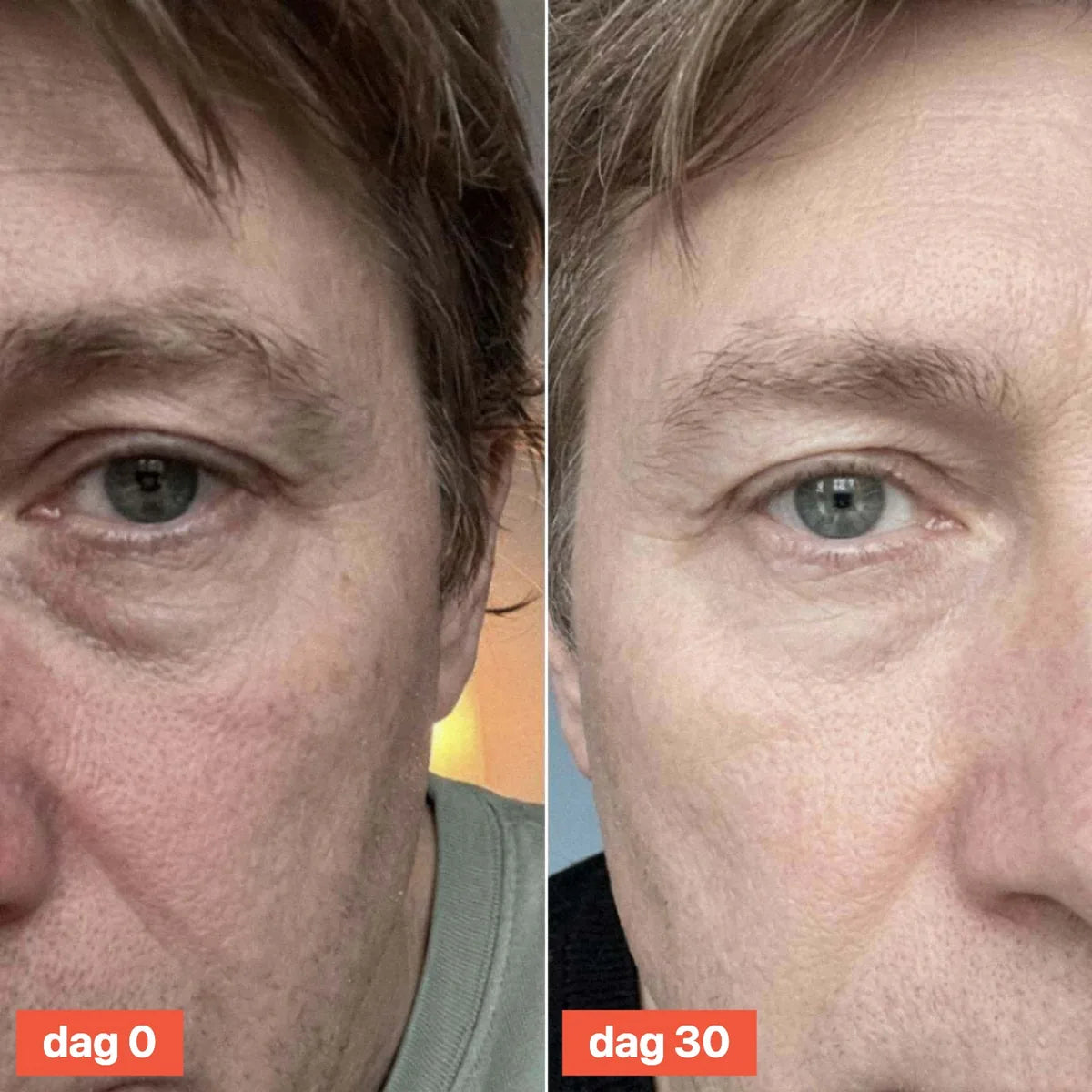 Close-up of a man's eye area on day 0 and day 30.